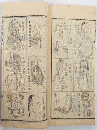 西醫略論. [Xiyi luelun]. [The First Lines of The Practice of Surgery in The West].